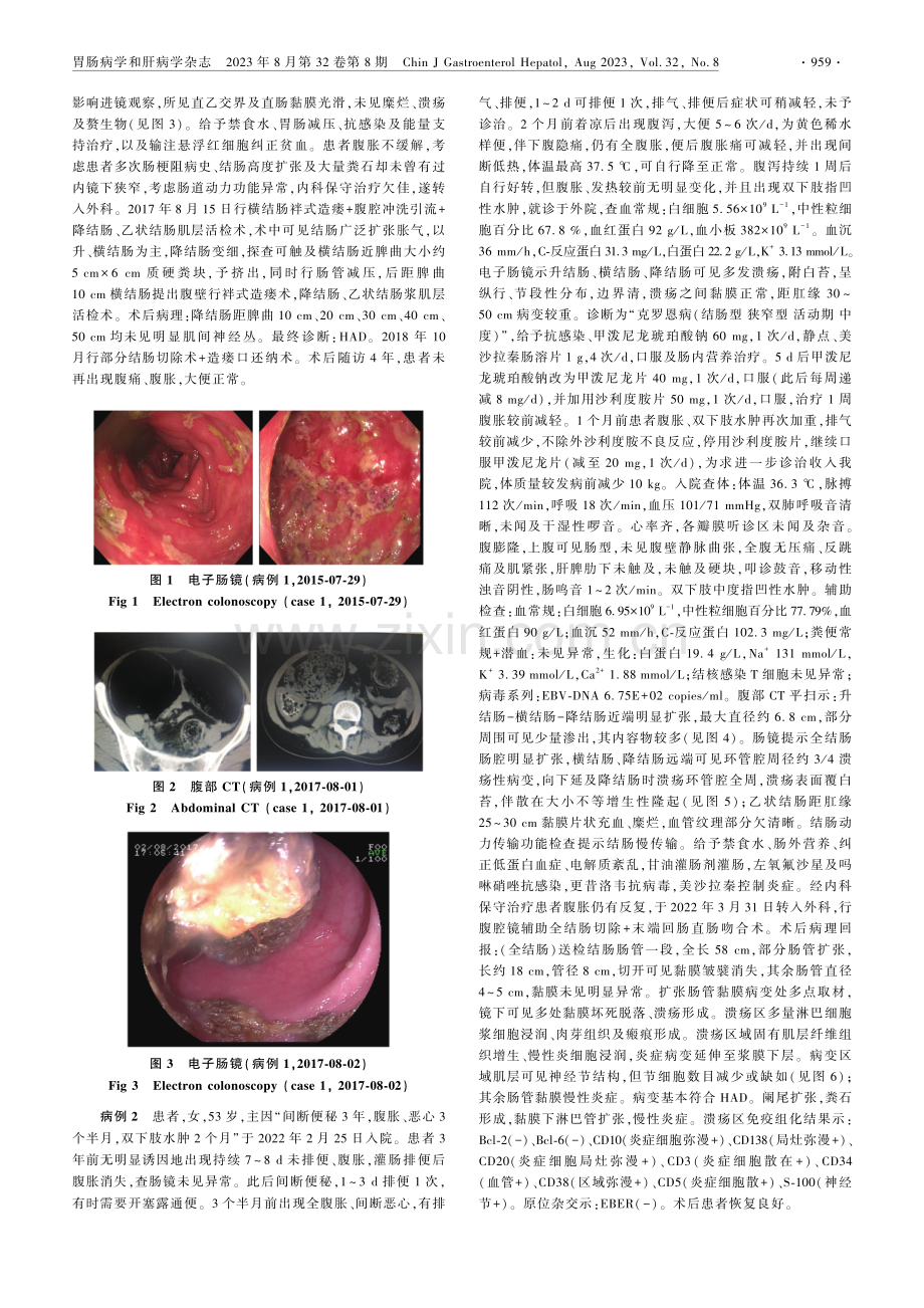 误诊为克罗恩病的成人巨结肠类缘病2例报道.pdf_第2页