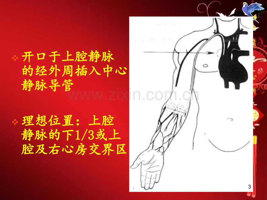 PICC常见并发症及处理护理查房PPT课件.ppt_第3页