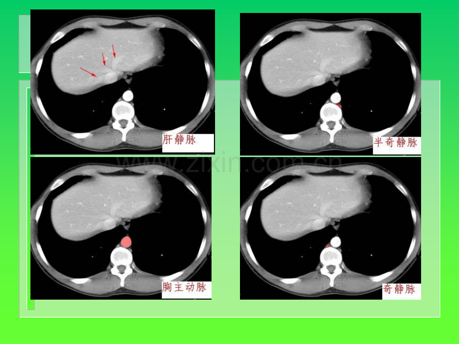 腹部C诊断ppt课件.ppt_第3页