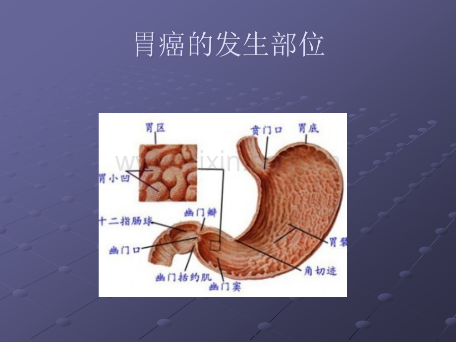 胃癌常见手术方式ppt课件.ppt_第3页