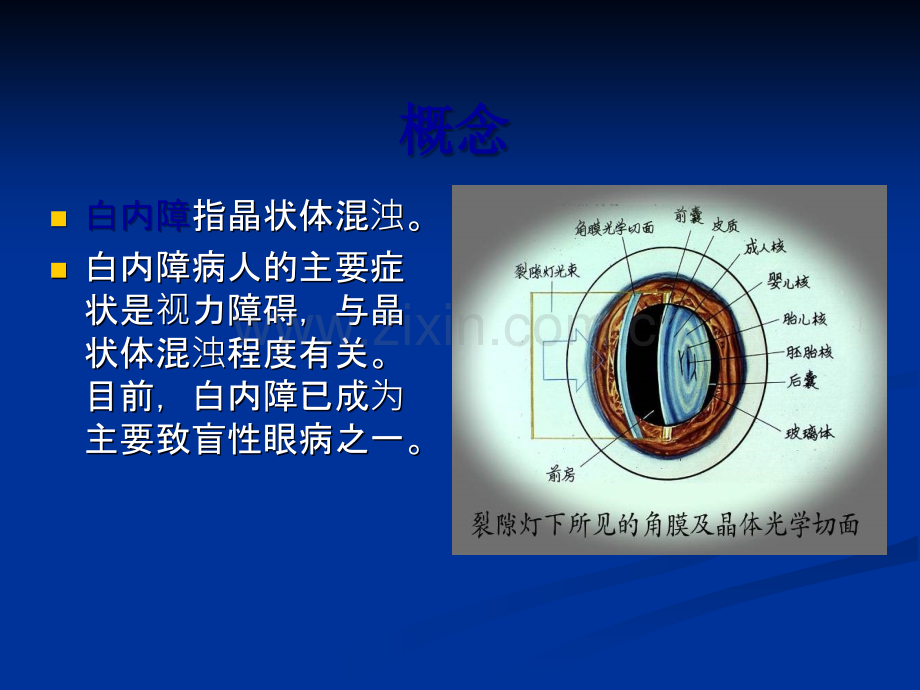 白内障护理ppt课件.ppt_第2页