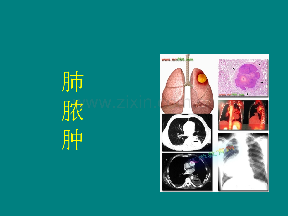 1例肺脓肿患者的病例汇报ppt课件.ppt_第2页