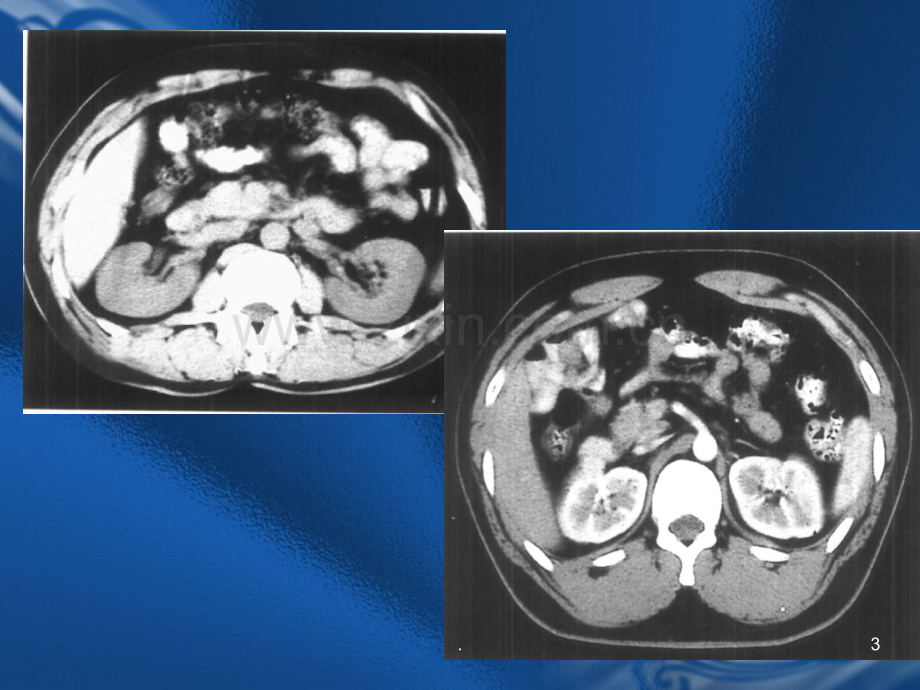 CT诊断学肾脏CTPPT课件.ppt_第3页