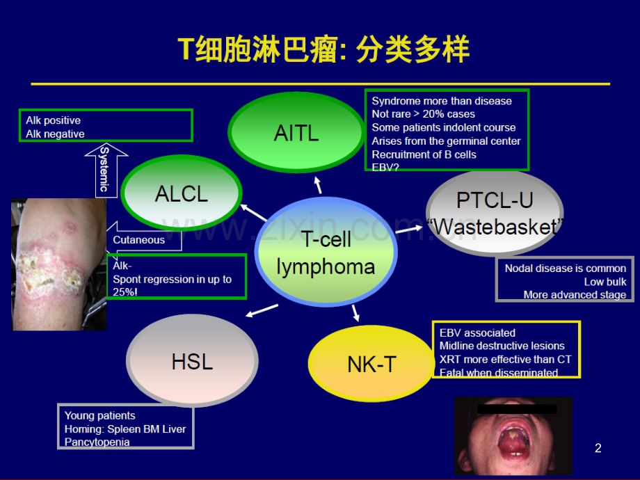 治疗外周T细胞淋巴瘤的新型药物PPT课件.pptx_第2页