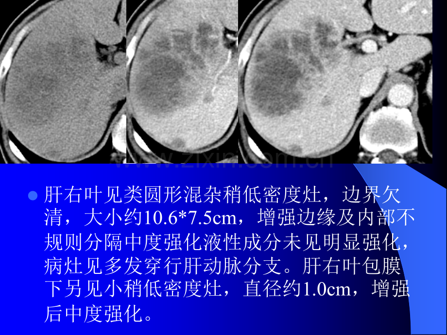 肝内胆管细胞癌和肝脓肿鉴别诊断ppt课件.ppt_第2页