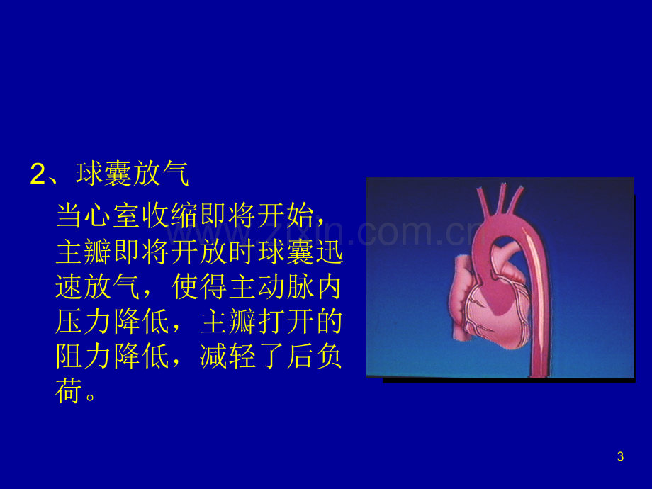 IABP使用常见问题.ppt_第3页