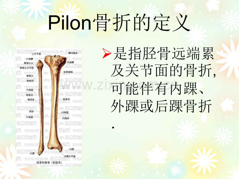 Pilon骨折的治疗策略与技巧ppt课件.ppt_第2页