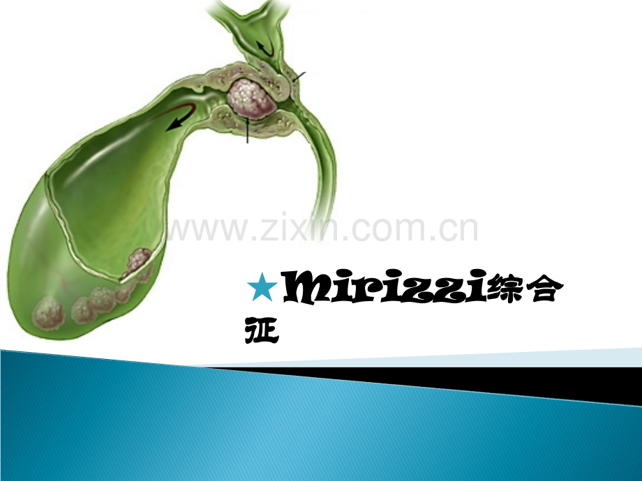 mirrizi综合征.ppt_第1页