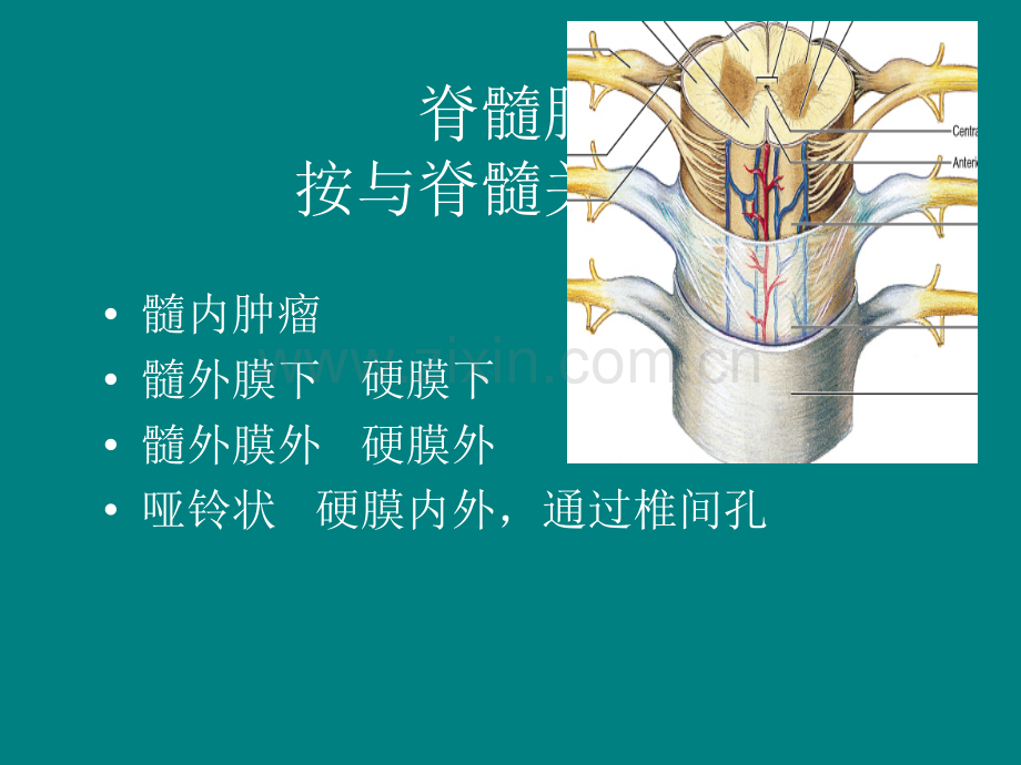 脊髓肿瘤ppt课件.pptx_第2页