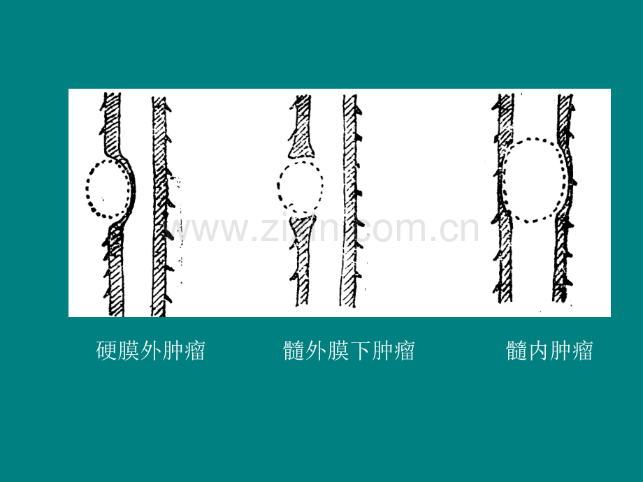 脊髓肿瘤ppt课件.pptx_第3页