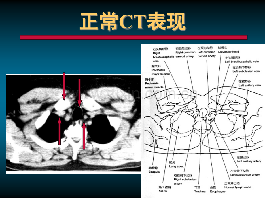 肺部正常CT.ppt_第1页