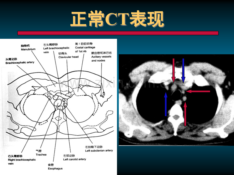 肺部正常CT.ppt_第3页