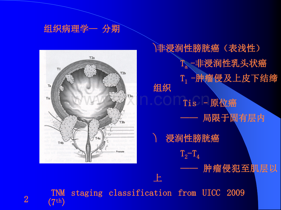 非肌层浸润性膀胱癌诊治中的几个问题ppt课件.ppt_第2页