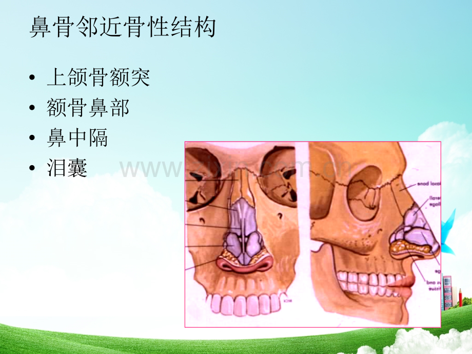 鼻骨骨折影像鉴别诊断.ppt_第3页