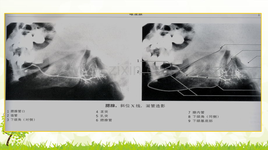 腮腺混合瘤的鉴别诊断ppt课件.pptx_第3页