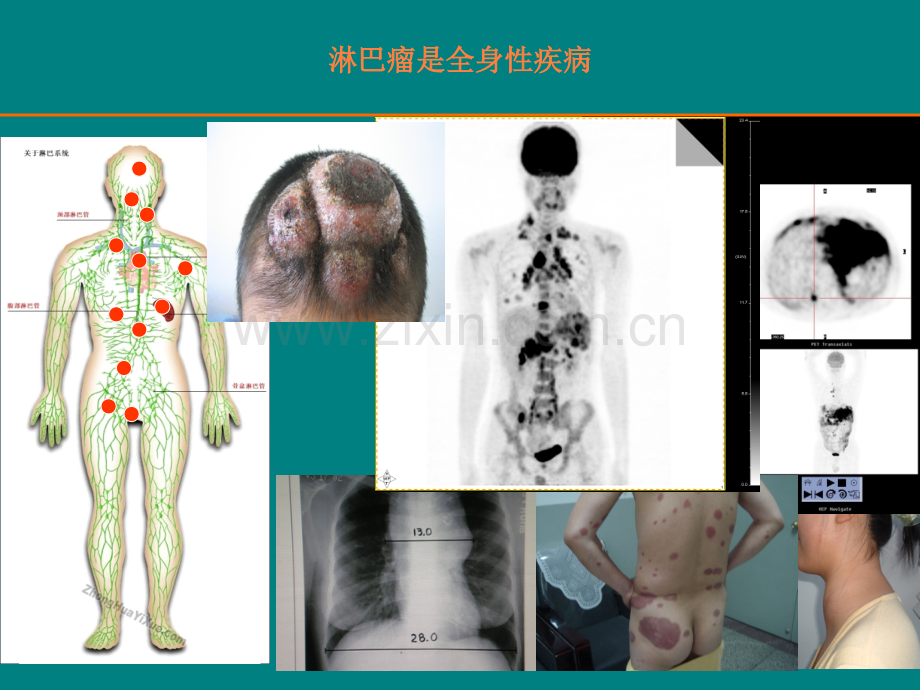 恶性淋巴瘤的放疗ppt课件.ppt_第2页