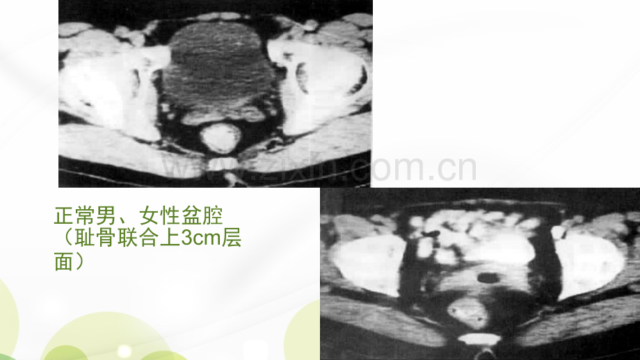 腹腔及腹膜后C诊断ppt课件.ppt_第3页