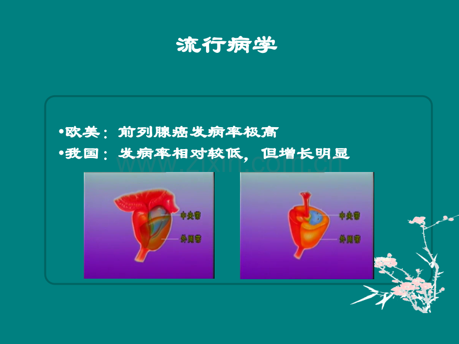 调强放疗在前列腺癌治疗中的应用.ppt_第2页