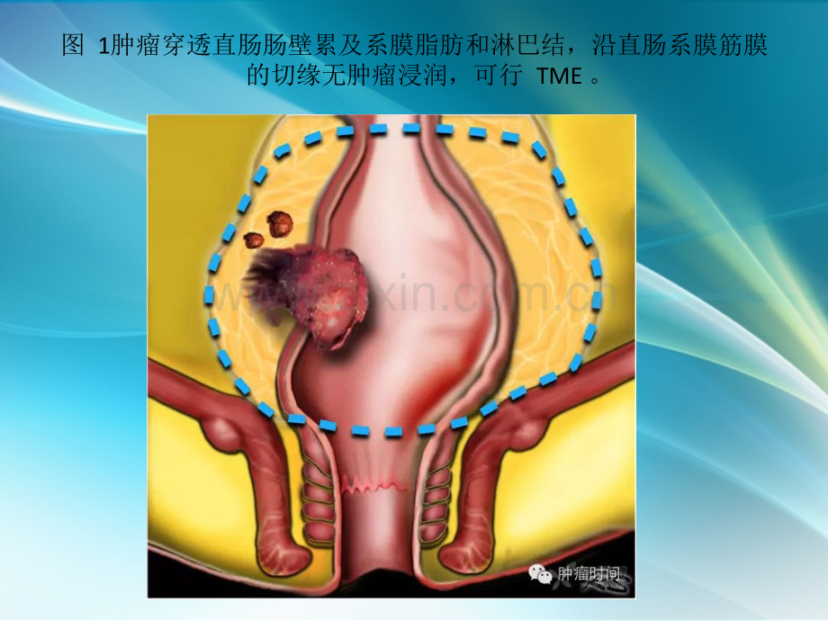 直肠癌诊疗图解.pptx_第3页