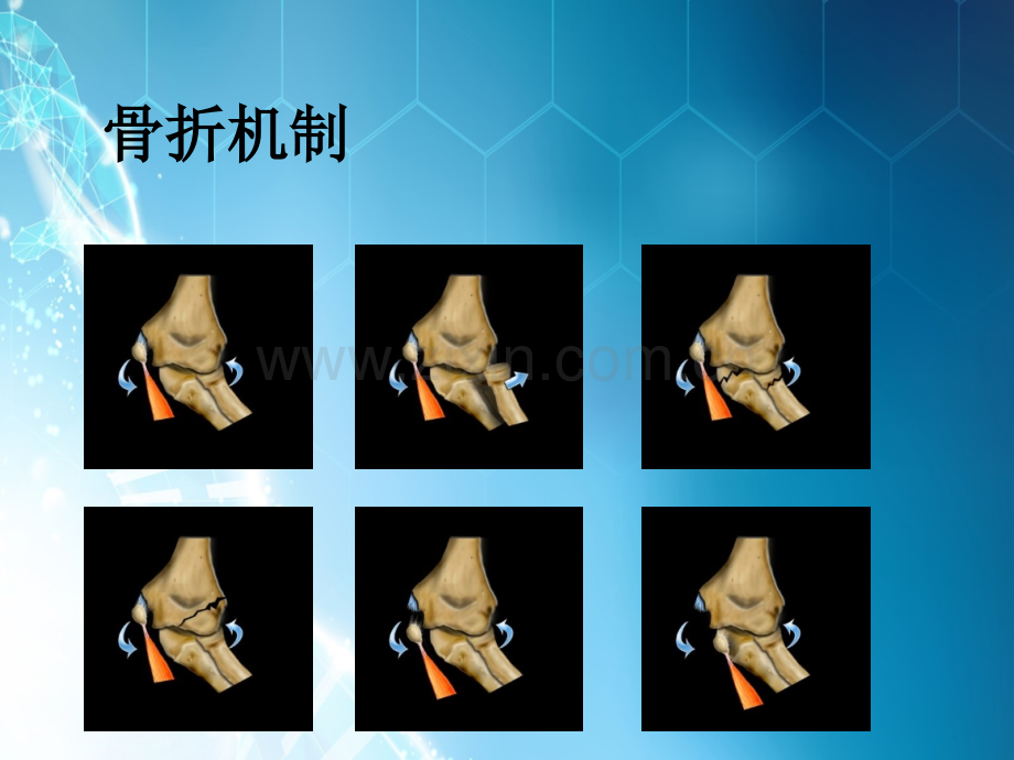 儿童肘关节骨折的X线诊断ppt课件.ppt_第3页