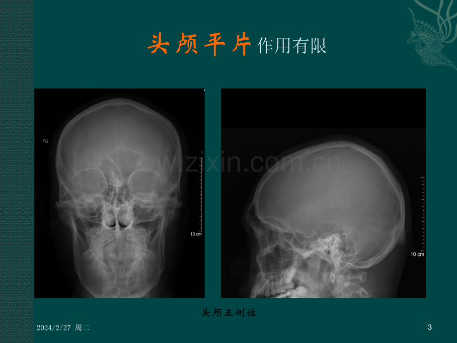 中枢神经系统总论、颅内肿瘤、颅脑外伤ppt课件.pptx_第3页