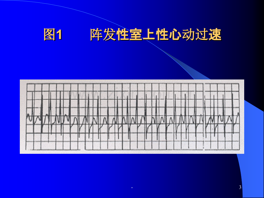 严重心律失常的诊断和急救处理PPT课件.ppt_第3页