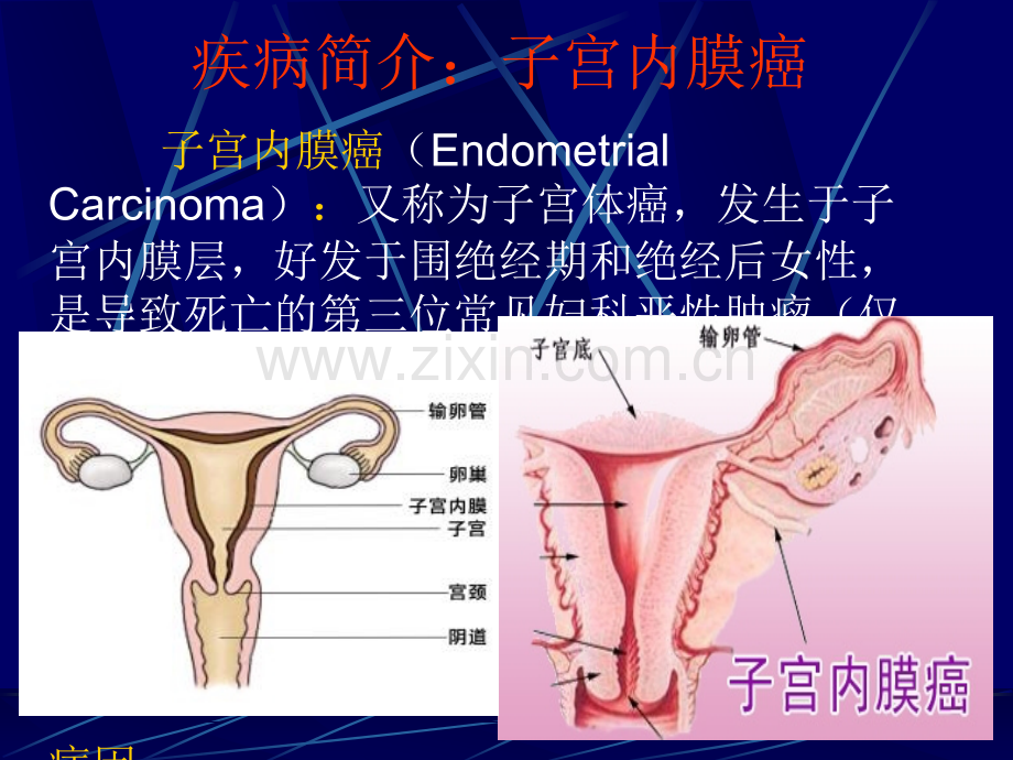 子宫内膜癌术后护理查房ppt课件.ppt_第3页