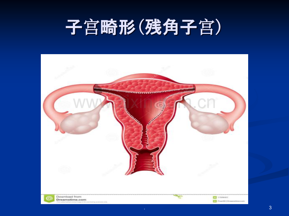 残角子宫课件.ppt_第3页