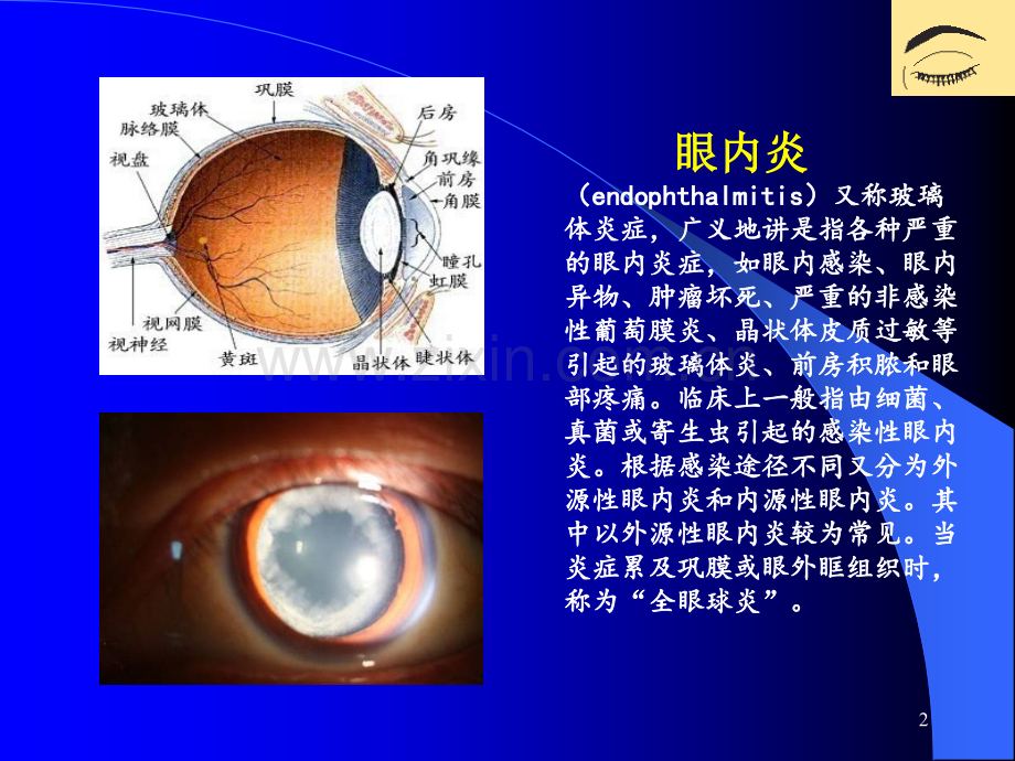 眼内炎患者的护理查房PPT课件.ppt_第2页