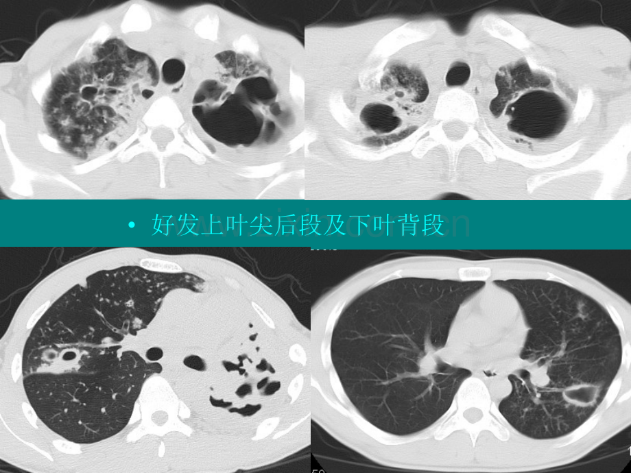 肺部单发空洞病灶的影像诊断.ppt_第3页