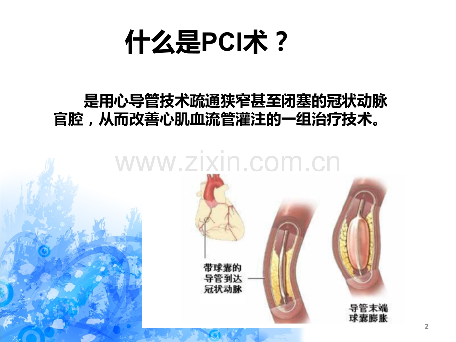 PCI术前术后的护理PPT课件.ppt_第2页