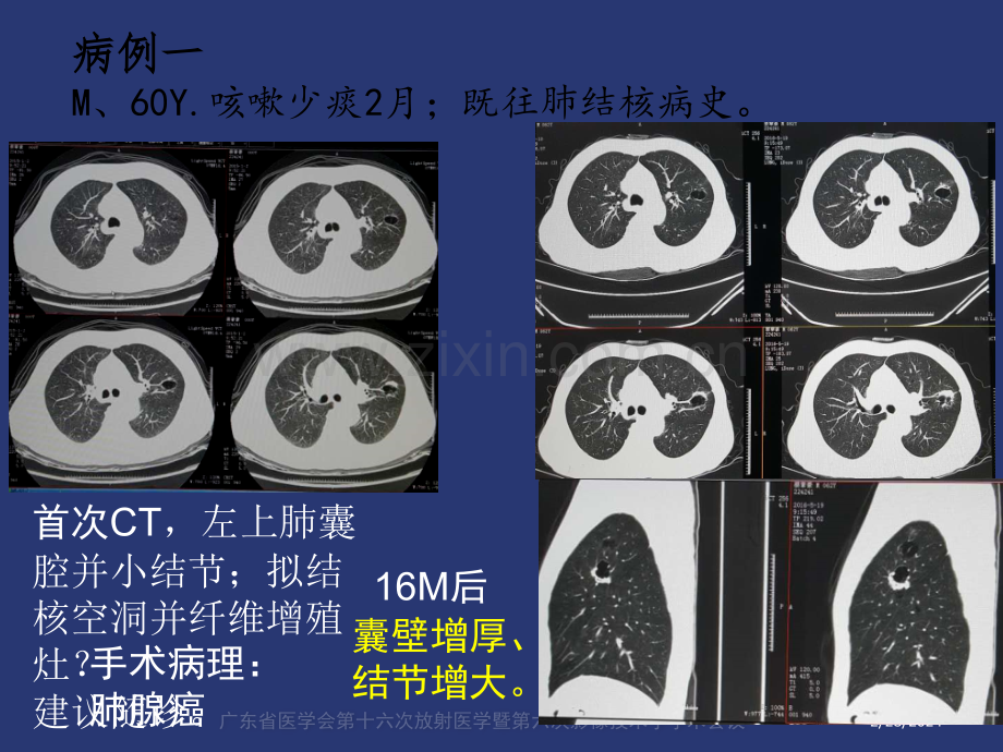 薄壁囊腔型肺癌的影像诊断和鉴别诊断liuppt课件.pptx_第2页