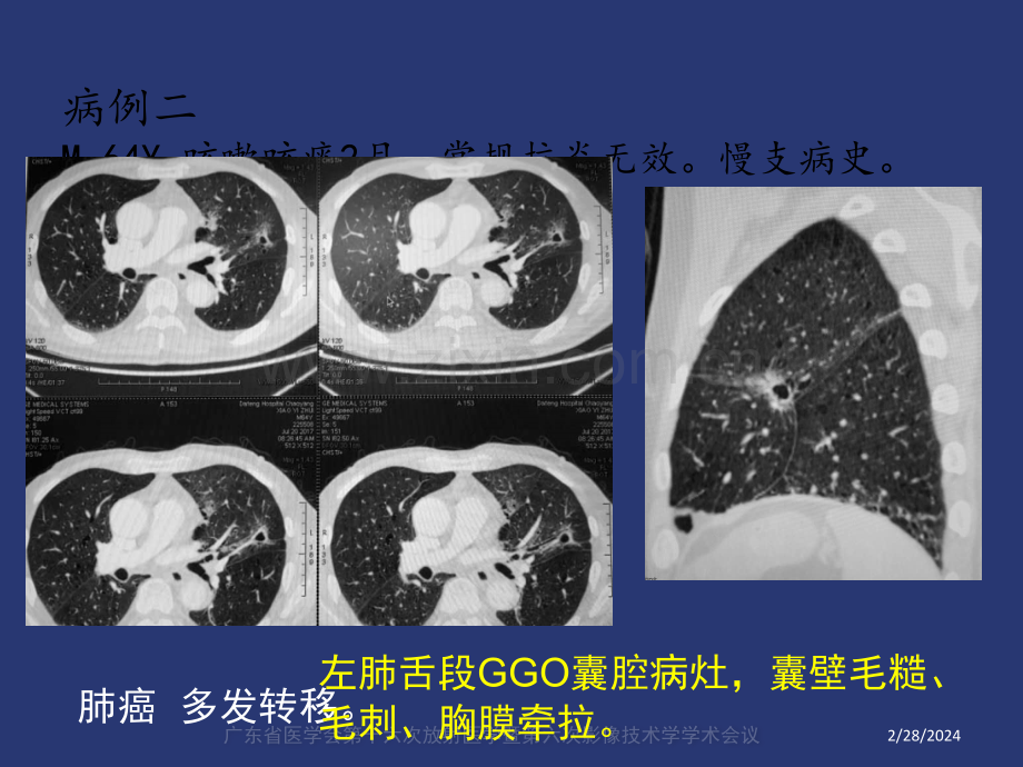 薄壁囊腔型肺癌的影像诊断和鉴别诊断liuppt课件.pptx_第3页