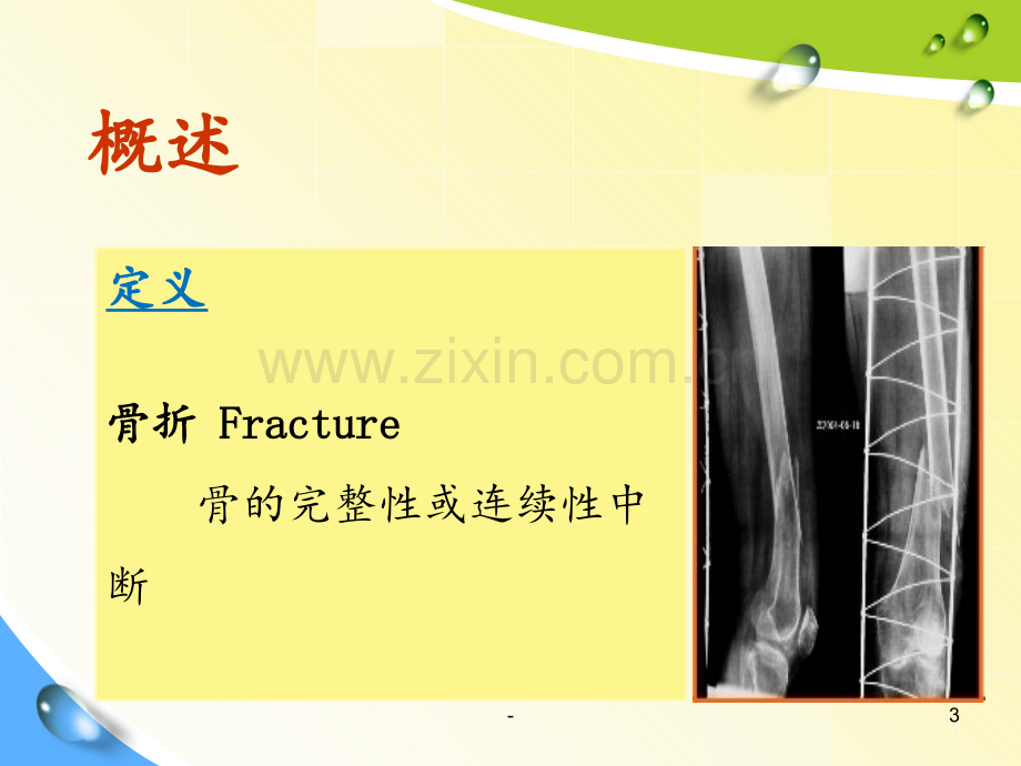 2018年骨科常见病护理常规与功能锻炼PPT课件.ppt_第3页