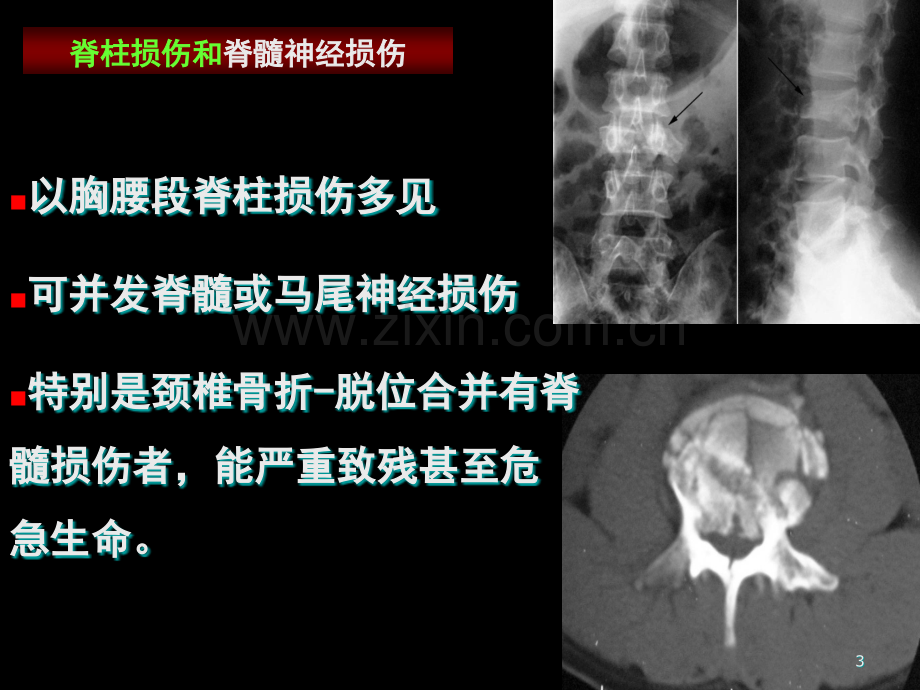 常见四肢脊柱外伤的紧急处理PPT课件.ppt_第3页