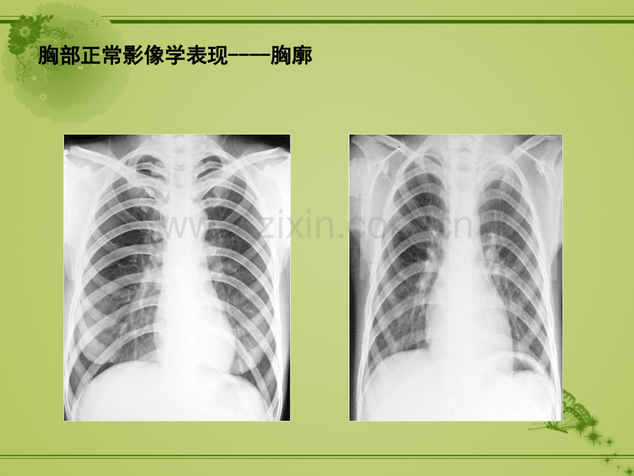 胸部X线正常及基本病变.pptx_第3页