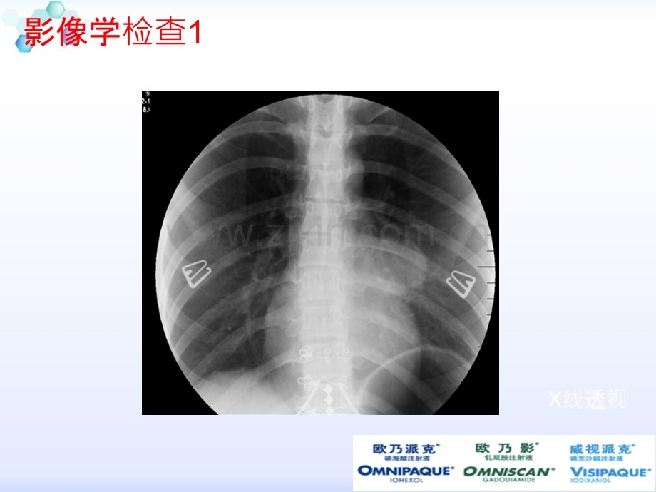 肺硬化性血管瘤.ppt_第3页