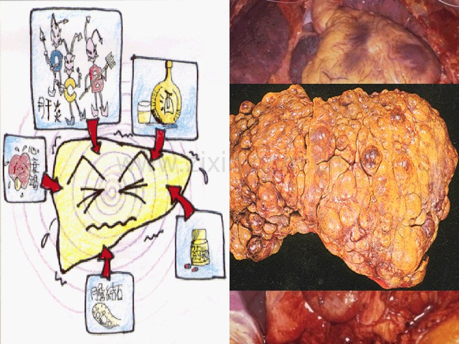 病理学肝硬化课件ppt课件.ppt_第2页