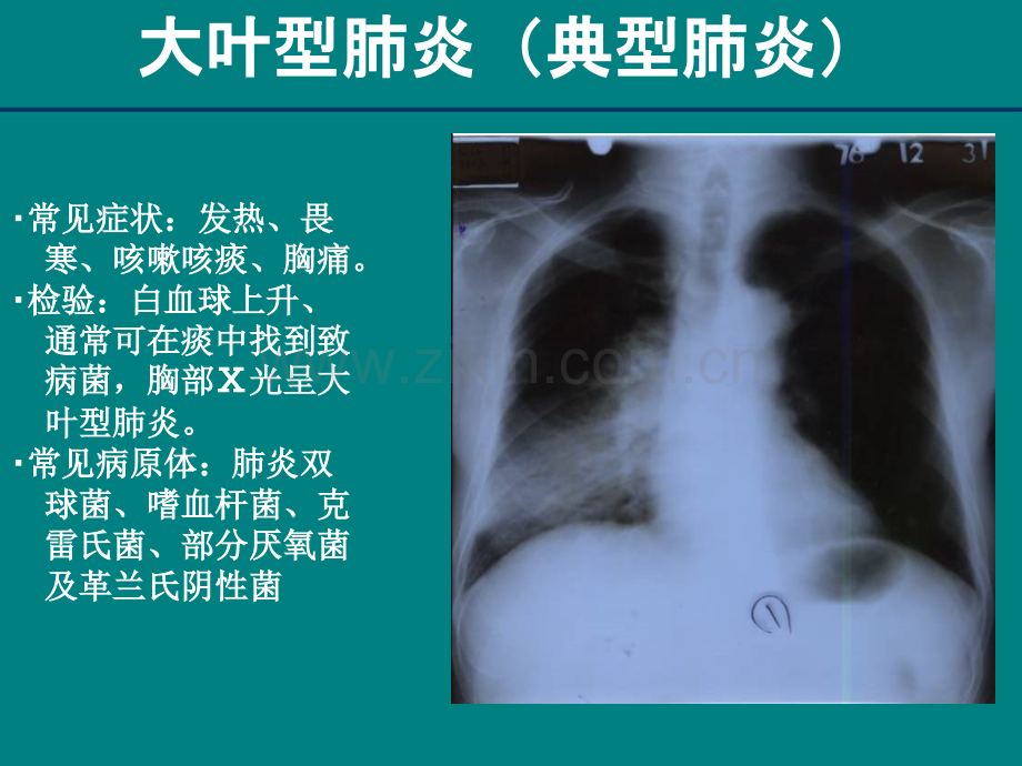 SARS病人的护理ppt课件.ppt_第3页