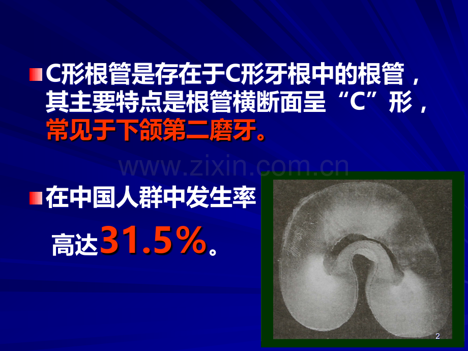 C形根管的形态、识别和治疗PPT课件.ppt_第2页