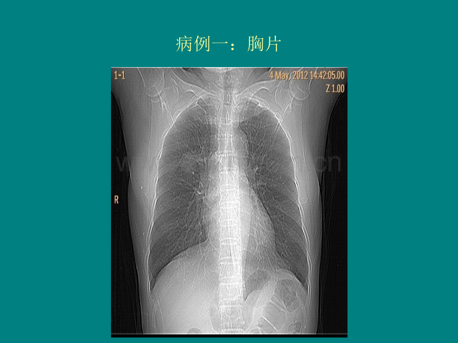 ocr病例读片ppt课件.pptx_第2页