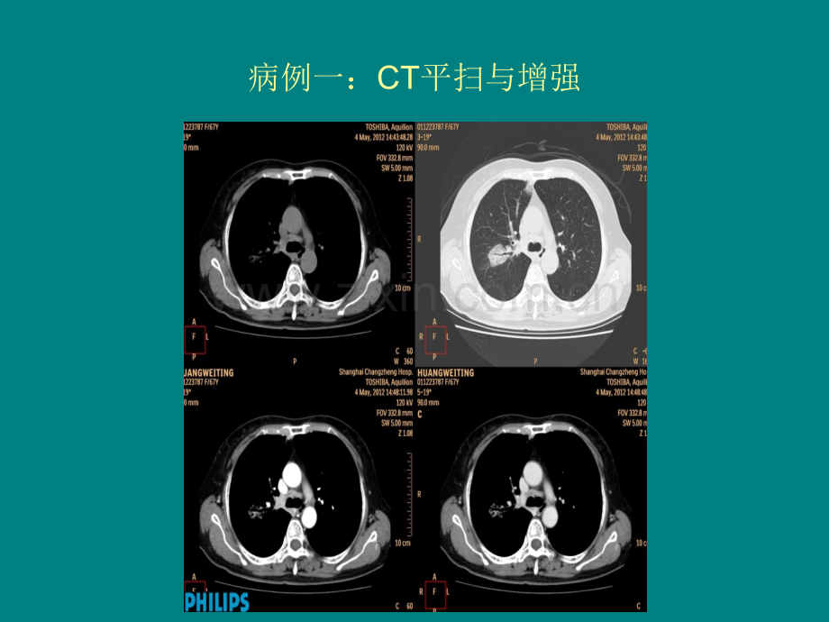 ocr病例读片ppt课件.pptx_第3页