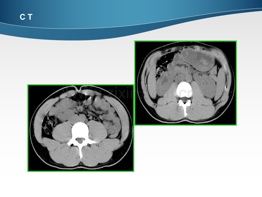 腹部影像诊断肾脏Cppt课件.ppt_第3页