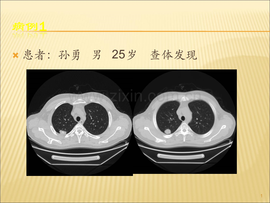 肺错构瘤影像表现.ppt_第1页