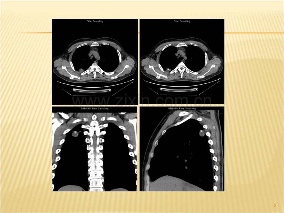 肺错构瘤影像表现.ppt_第2页