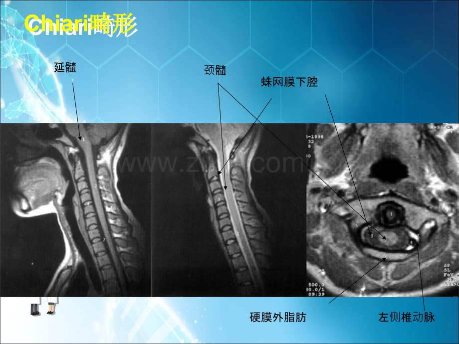 MRI图像脑-(2)ppt课件.ppt_第1页