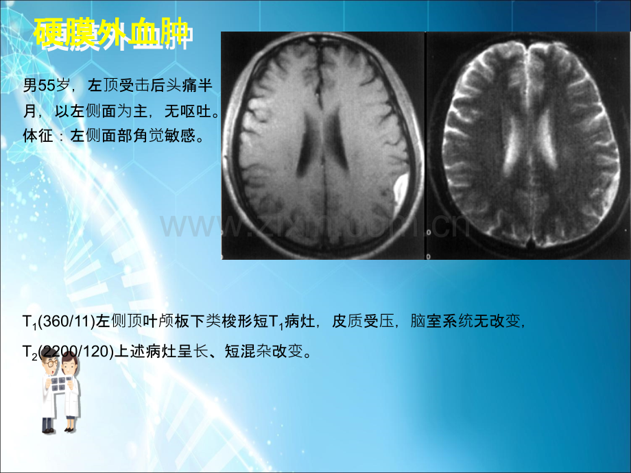 MRI图像脑-(2)ppt课件.ppt_第3页