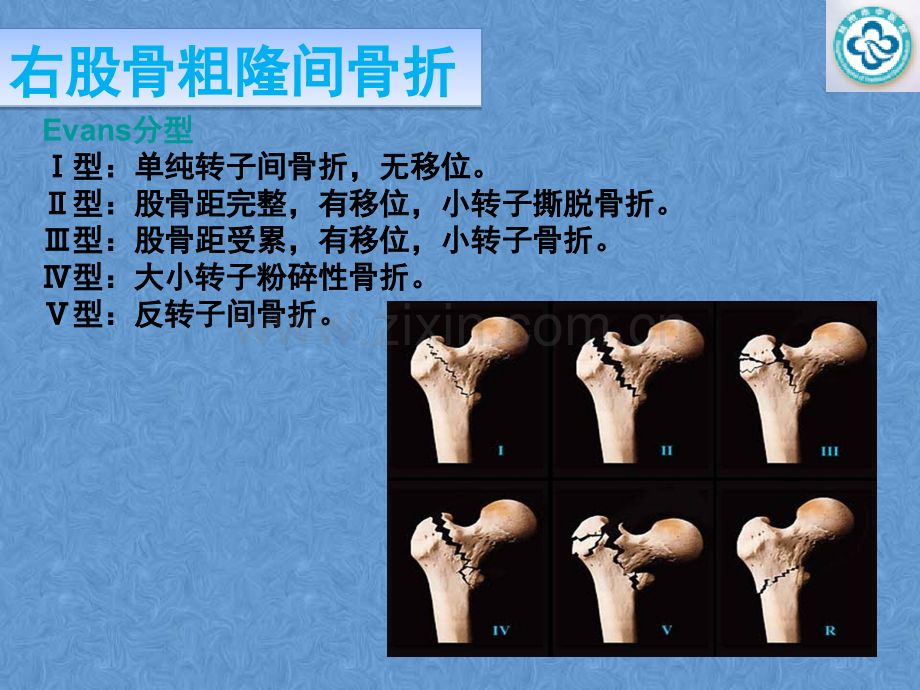 左股骨粗隆间骨折护理查房.ppt_第3页