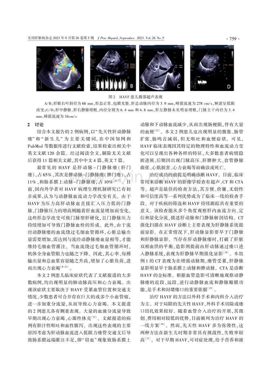 新生儿先天性肝动静脉瘘：病例报告及文献复习.pdf_第3页