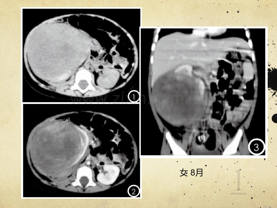肾母细胞瘤ppt课件.pptx_第1页